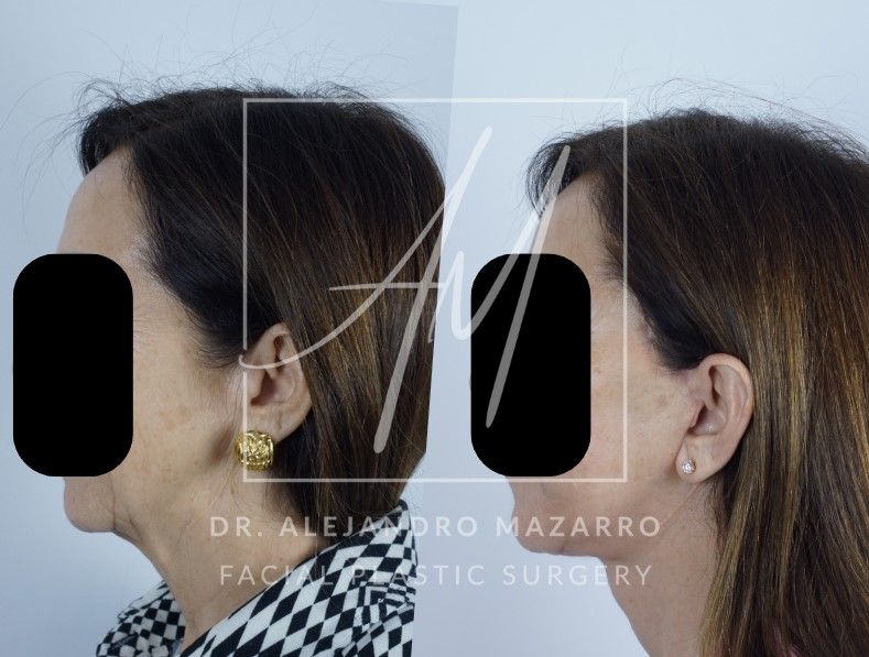 Preservation  Deep Plane Facelift- Dr. Mazarro