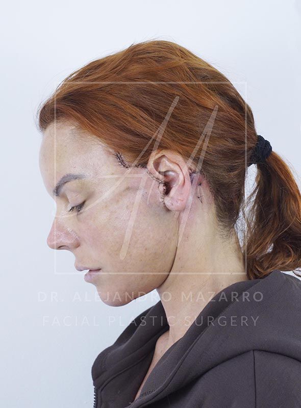 Paciente de 47 años a las 48 horas de Preservation Deep Plane Facelift, con inflamación leve y equimosis. Realizado por el Dr. Mazarro.