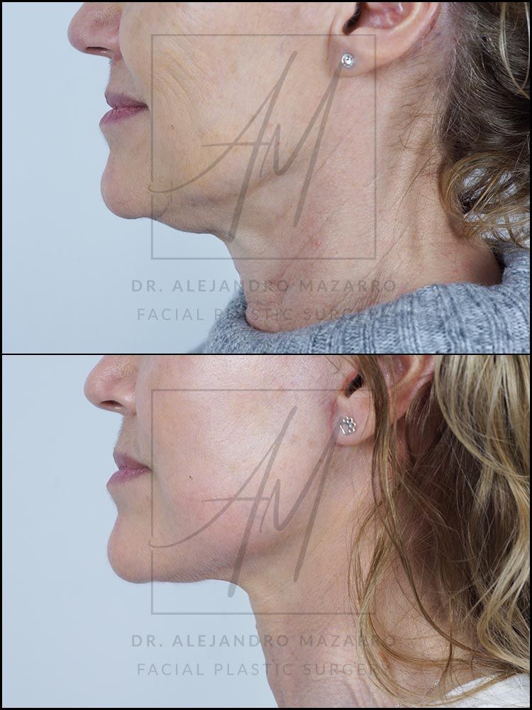 7-week result of preservation facelift in a 55-year-old woman, left straight profile with rejuvenated facial contour and defined neck. Performed by Dr. Mazarro.