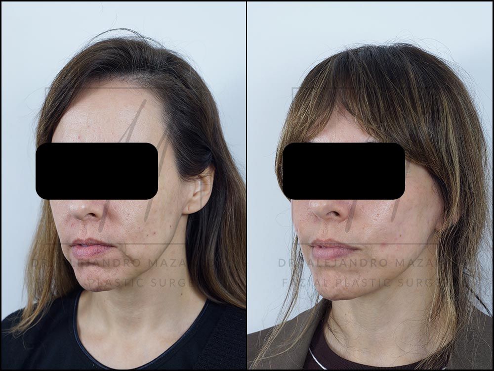 Pacient dona 44 anys - Vista 3/4 esquerra abans i després de Lifting Cervicofacial Deep Plane de Preservació a 4 mesos pel Dr. Alejandro Mazarro a Barcelona.