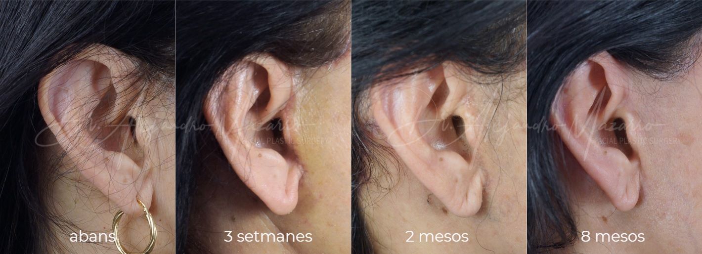 Evolució de les cicatrius de lifting - Dr. Mazarro