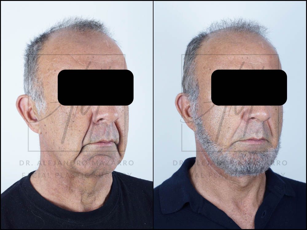 Antes y después Lifting Deep Plane 2 meses después - Caso 1 / Dr. Mazarro