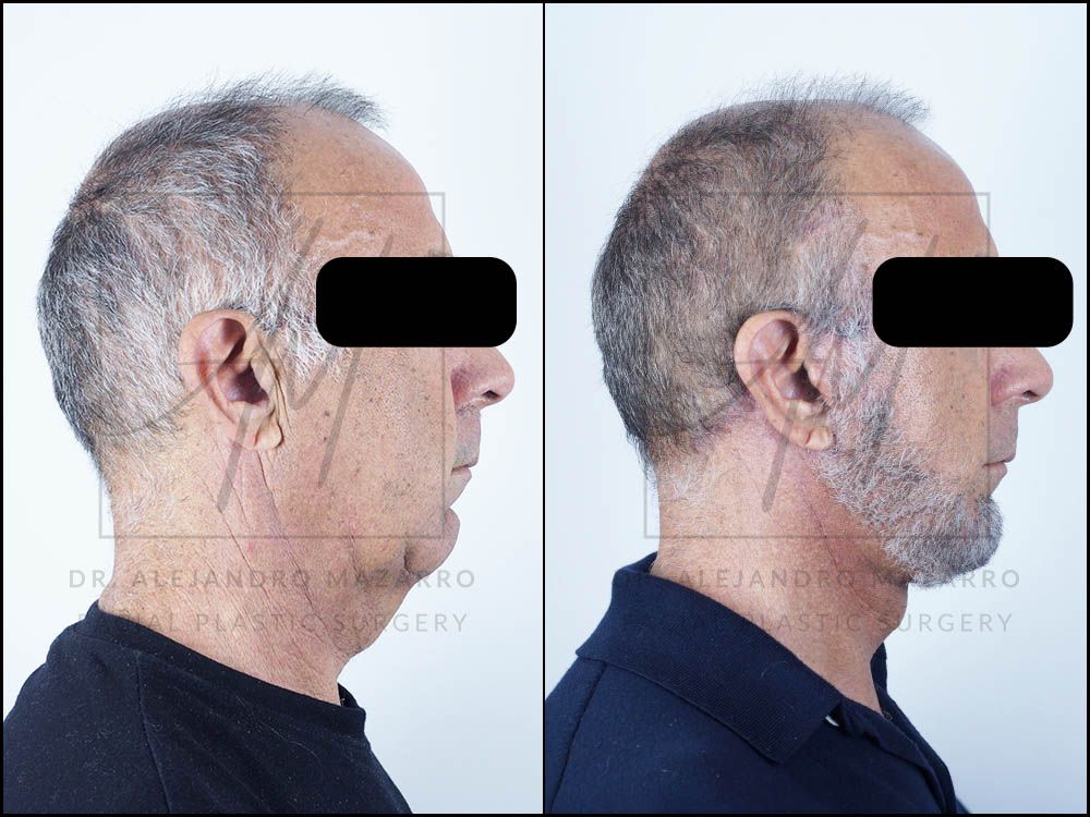 Antes y después Lifting Deep Plane 2 meses después - Caso 1 / Dr. Mazarro