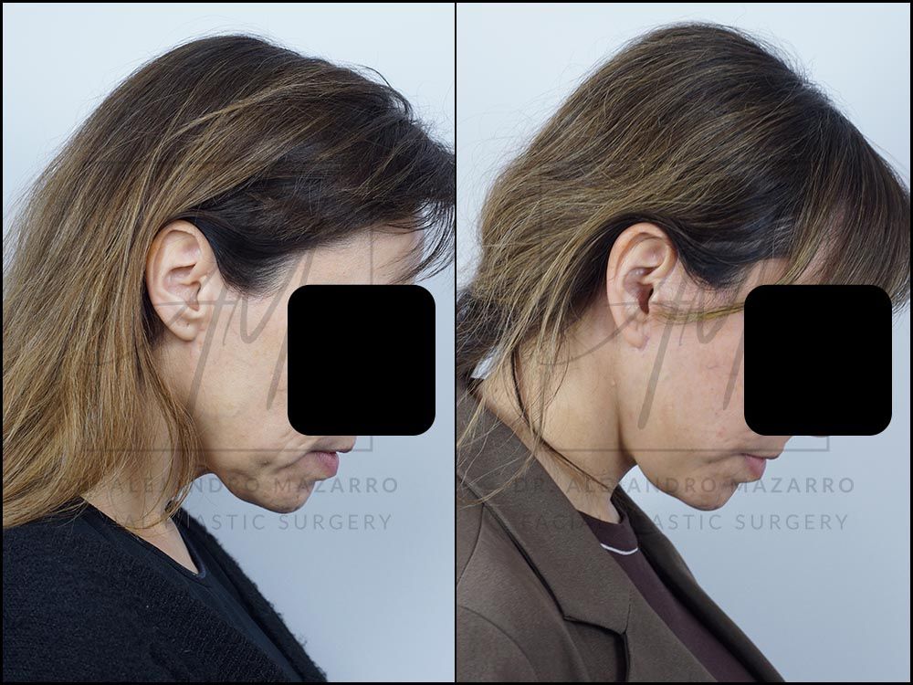 Pacient dona 44 anys - Vista de perfil dret amb mentó cap avall abans i després de Lifting Cervicofacial Deep Plane de Preservació a 4 mesos pel Dr. Alejandro Mazarro a Barcelona.