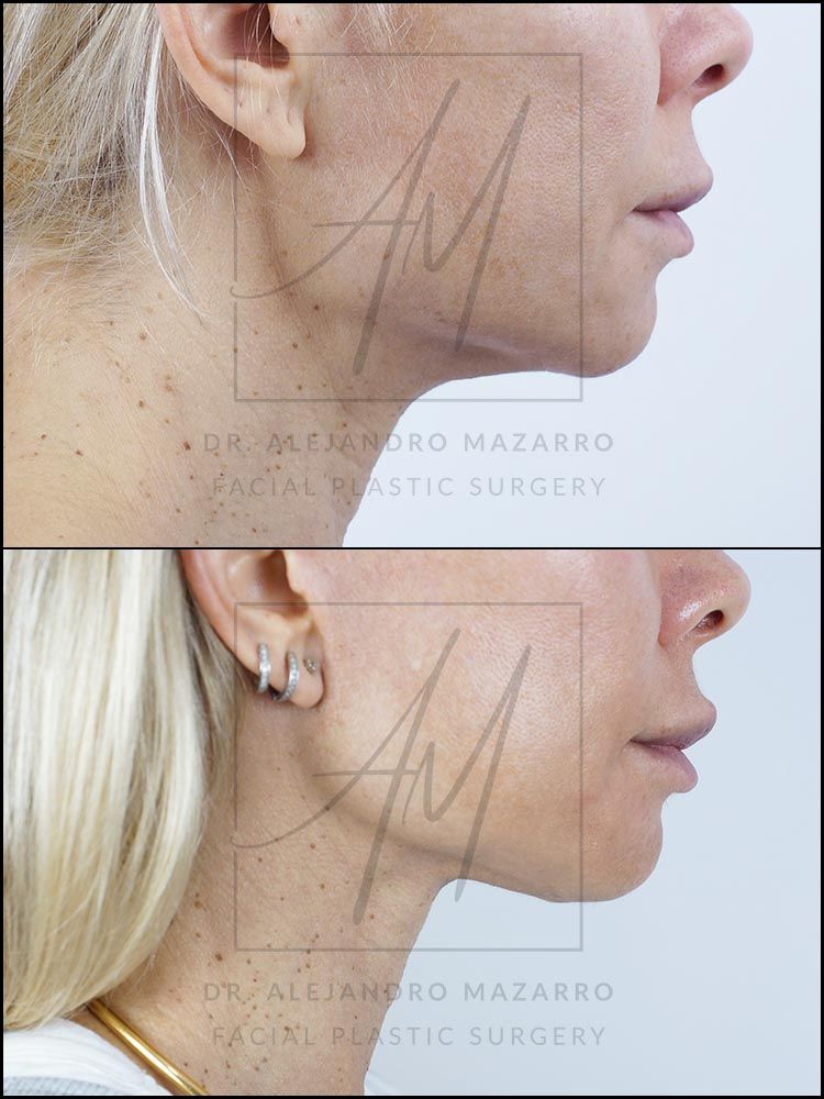 9-month result of preservation deep plane facelift and deep neck lift in a 44-year-old woman, right straight profile showing rejuvenated facial contour and defined neck. Performed by Dr. Mazarro.