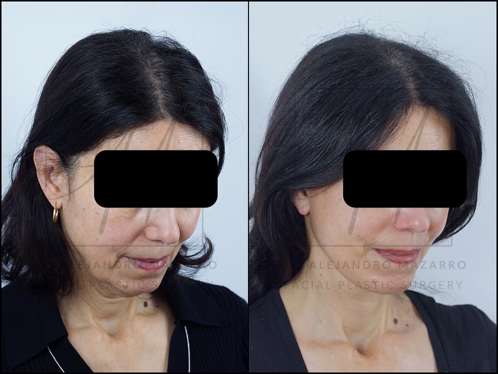 Pacient dona 58 anys - Vista 3/4 dreta amb mentó cap avall abans i després de Lifting Cervicofacial Deep Plane de Preservació a 8 mesos pel Dr. Alejandro Mazarro a Barcelona.