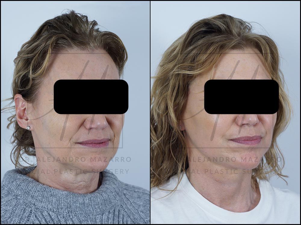 7-week result of preservation cervicofacial facelift in a 55-year-old woman, right 3/4 view with rejuvenated facial contour and defined neck. Performed by Dr. Mazarro.