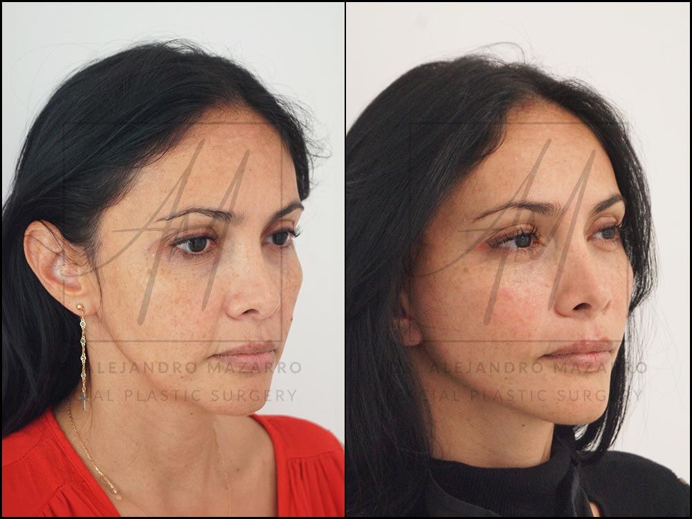 1-month result of preservation deep plane facelift in a 44-year-old woman, right 3/4 view with rejuvenated facial contour and cervical definition. Performed by Dr. Mazarro.