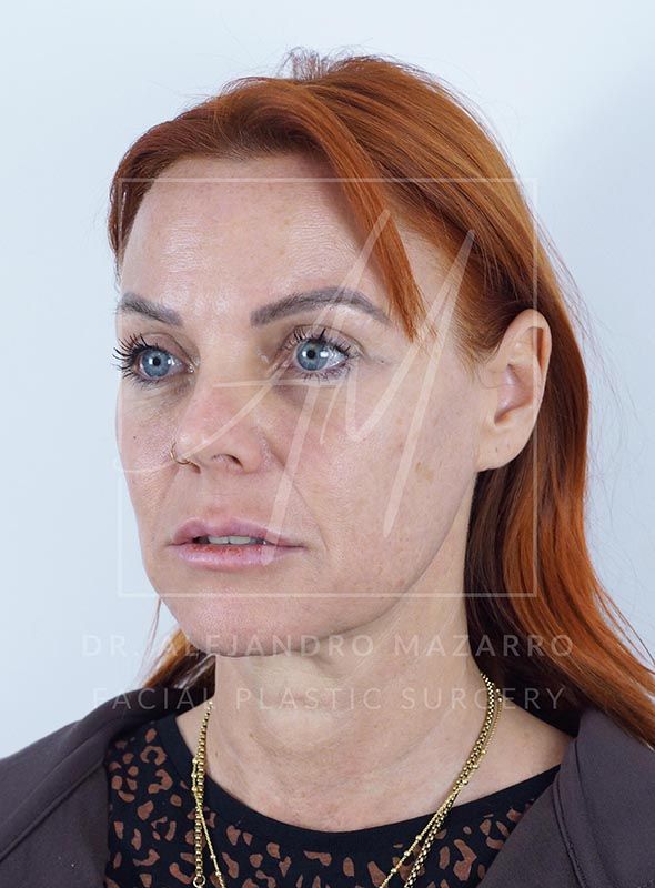 47-year-old patient before Preservation Deep Plane Facelift, with cervical laxity and loss of jawline definition. Case by Dr. Mazarro.