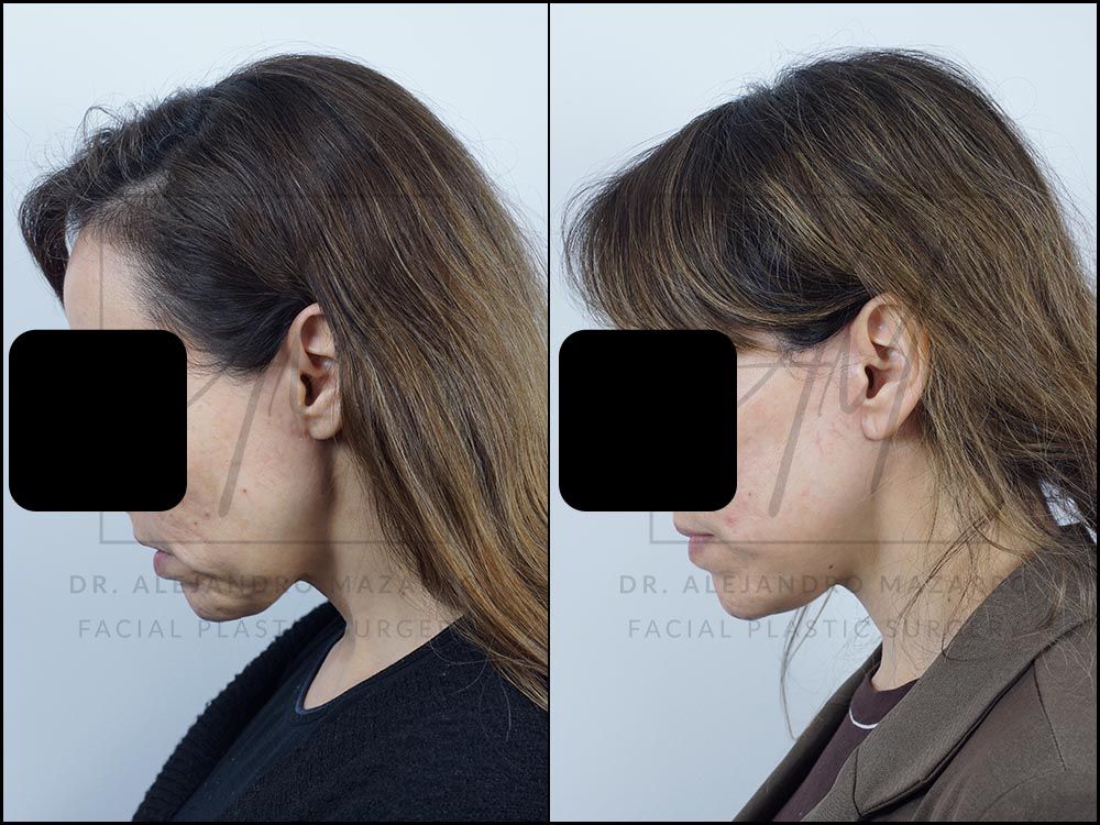 Pacient dona 44 anys - Vista de perfil esquerre amb mentó cap avall abans i després de Lifting Cervicofacial Deep Plane de Preservació a 4 mesos pel Dr. Alejandro Mazarro a Barcelona.