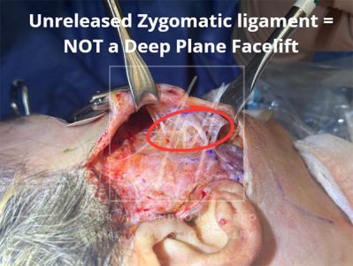 Fake Deep Plane facelift - zygomatic ligament not released