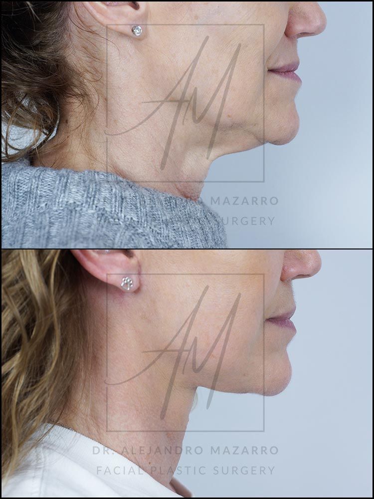 Pacient dona 55 anys - Vista de perfil dret abans i després de Lifting Cervicofacial Deep Plane de Preservació a 7 setmanes pel Dr. Alejandro Mazarro a Barcelona.