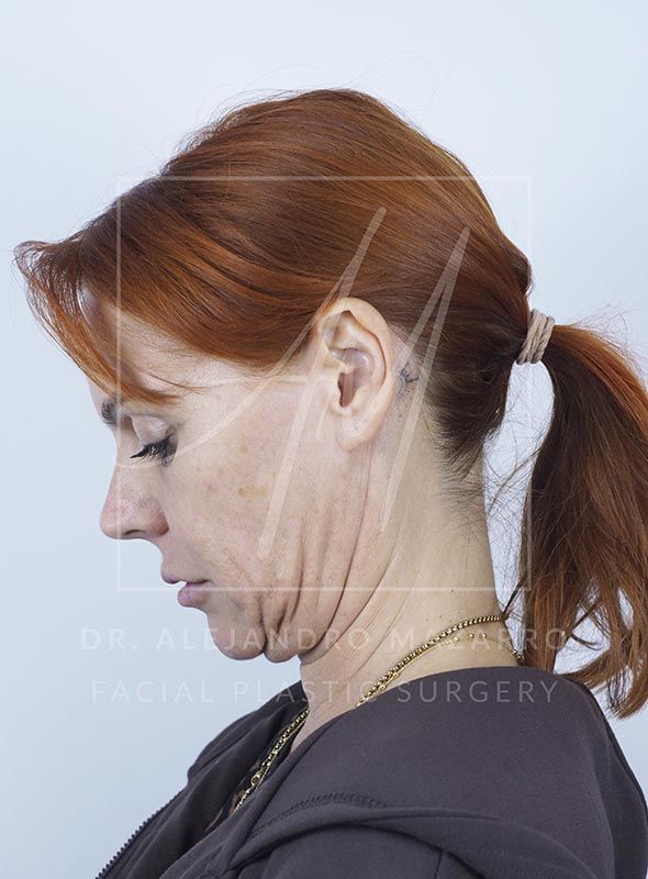 Paciente de 47 años a las 48 horas de Preservation Deep Plane Facelift, con inflamación leve y equimosis. Realizado por el Dr. Mazarro.