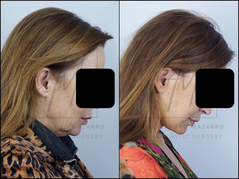 Preservation Deep Plane Facelift- Dr. Mazarro