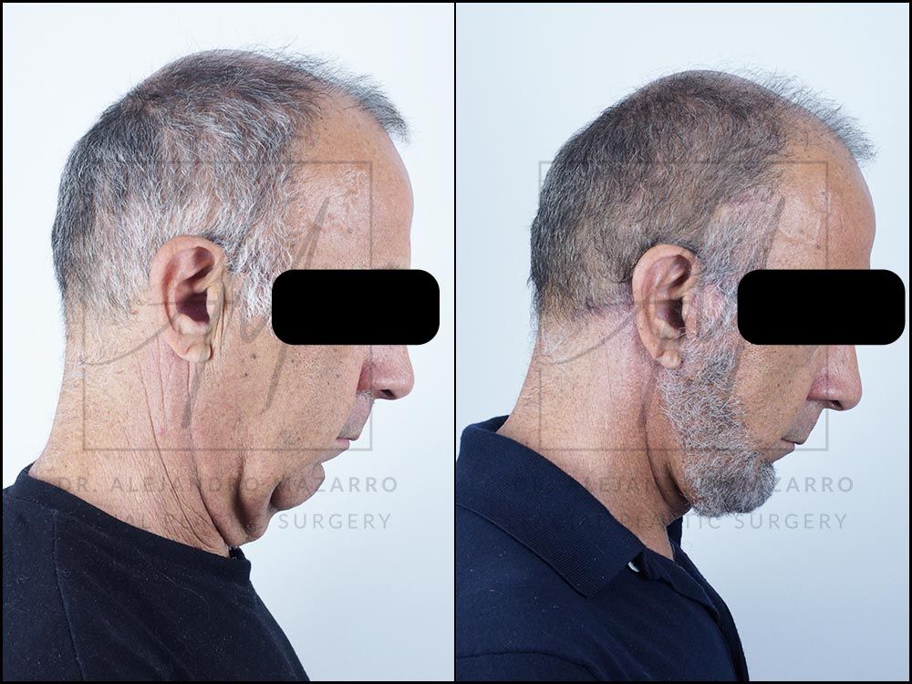 Antes y después Lifting Deep Plane 2 meses después - Caso 1 / Dr. Mazarro