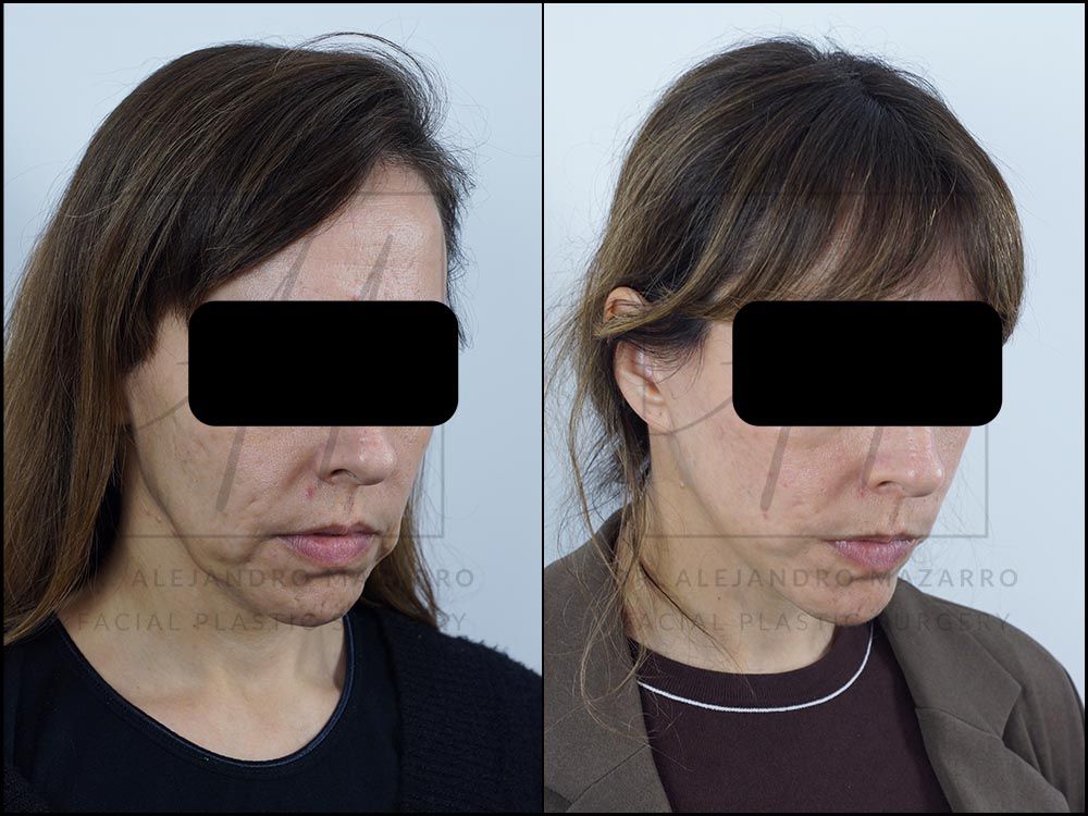 Pacient dona 44 anys - Vista 3/4 dreta amb mentó cap avall abans i després de Lifting Cervicofacial Deep Plane de Preservació a 4 mesos pel Dr. Alejandro Mazarro a Barcelona.