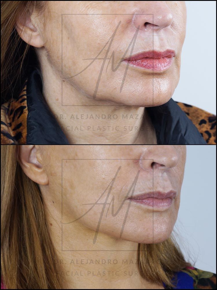 Pacient dona 53 anys - Vista 3/4 dreta abans i després de Lifting Cervicofacial Deep Plane de Preservació a 4 mesos pel Dr. Alejandro Mazarro a Barcelona.
