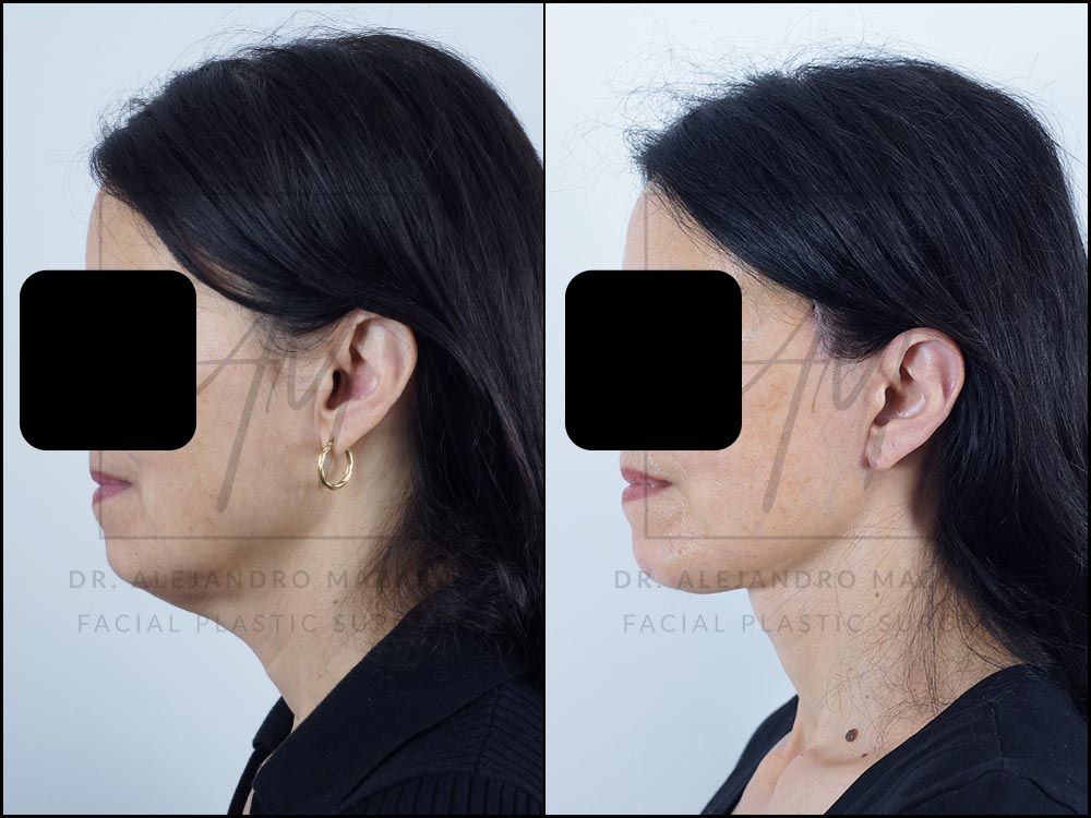 Resultado a los 8 meses de lifting deep plane de preservación y deep neck lift en mujer de 56 años, perfil izquierdo con contorno facial armonioso y cuello rejuvenecido. Realizado por el Dr. Mazarro.
