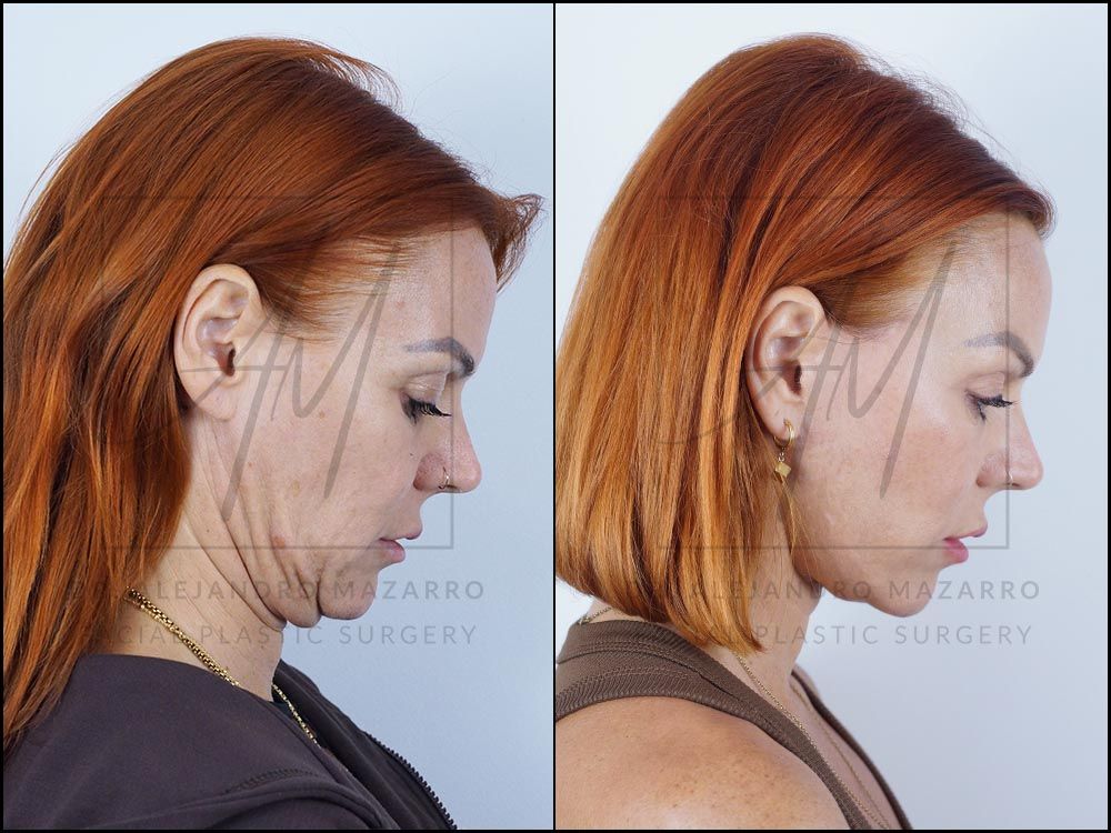 Resultado a los 8 meses de lifting deep plane de preservación en mujer de 47 años, perfil con mentón hacia abajo mostrando la definición y naturalidad del cuello rejuvenecido. Realizado por el Dr. Mazarro.