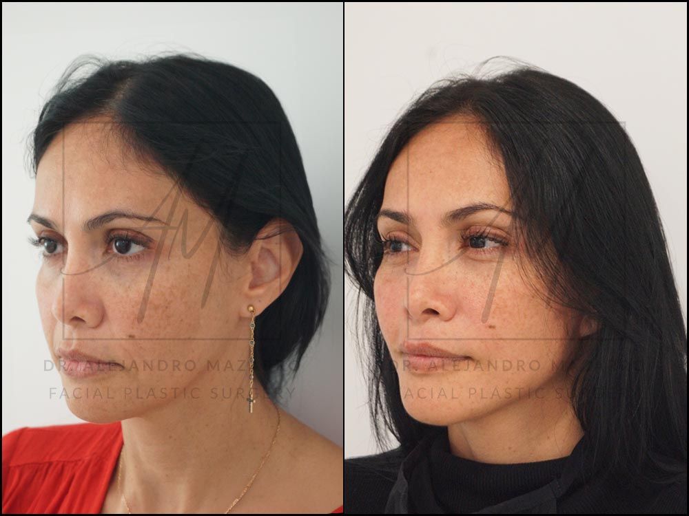 1-month result of preservation deep plane facelift in a 44-year-old woman, right 3/4 view with rejuvenated facial contour and cervical definition. Performed by Dr. Mazarro.