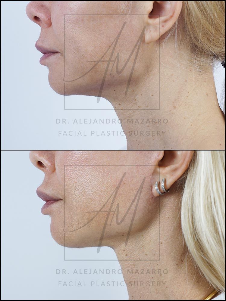 9-month result of preservation deep plane facelift and deep neck lift in a 44-year-old woman, left straight profile showing rejuvenated facial contour and defined neck. Performed by Dr. Mazarro.