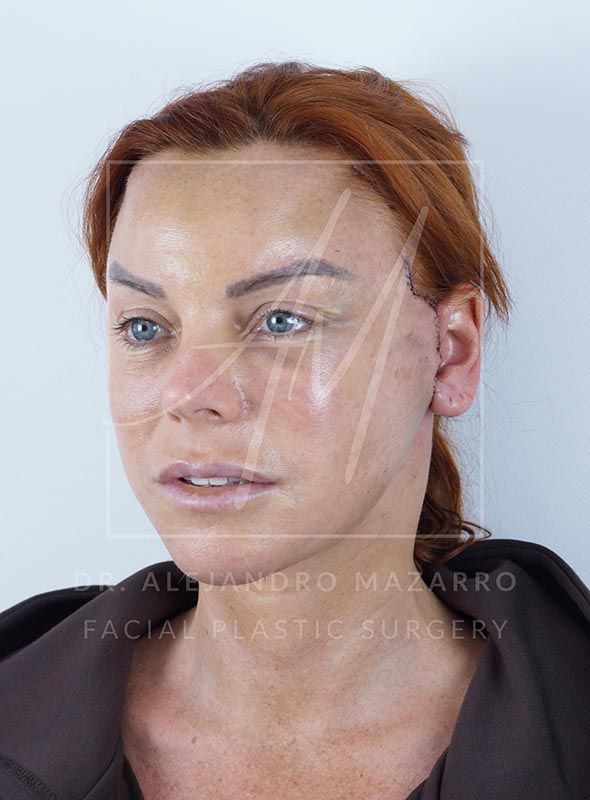 48h post-op Preservation Deep Plane Facelift Dr. Mazarro case 2447 view 3/4