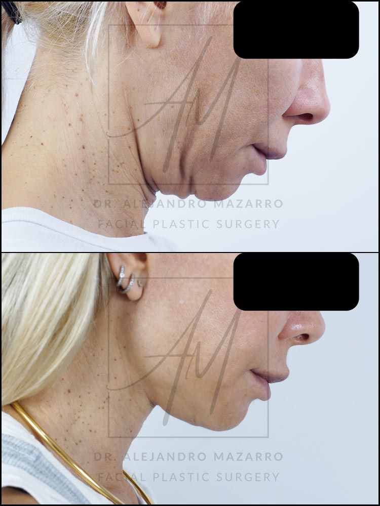 9-month result of preservation deep plane facelift and deep neck lift in a 44-year-old woman, right profile with chin down showing the definition and elegance of the rejuvenated neck. Performed by Dr. Mazarro.