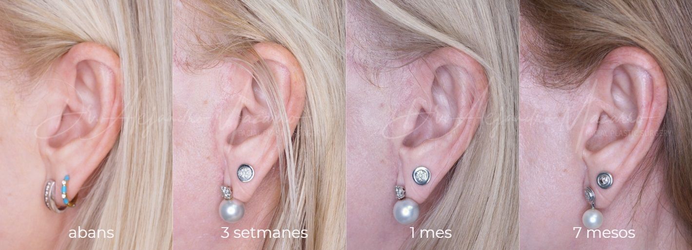 Evolució de les cicatrius de lifting - Dr. Mazarro