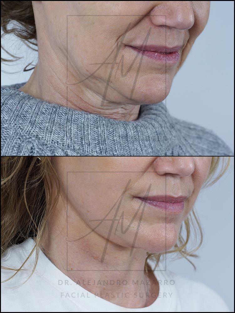 7-week result of preservation facelift in a 55-year-old woman, right 3/4 view with chin down showing the definition and naturalness of the rejuvenated neck. Performed by Dr. Mazarro.