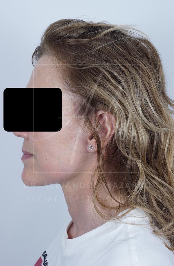 Postoperatorio lifting Deep Plane 6 semanas Barcelona Paciente Dr Mazarro