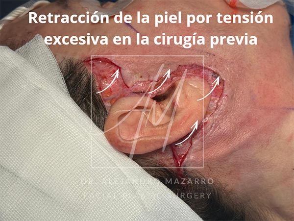 Retracción de la piel por tensión excesiva en la cirugía previa