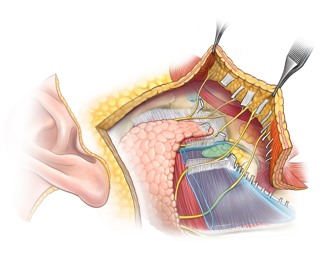 Facial nerve relationship with musculature in Deep Plane facelift