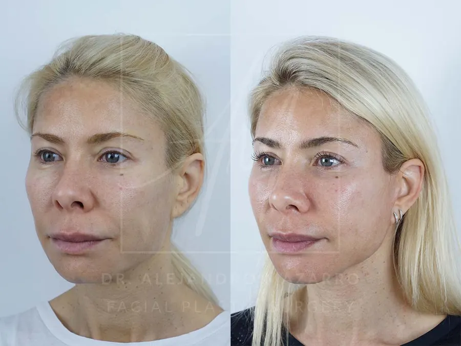 Lifting facial / Deep Plane Facelift- Dr. Mazarro