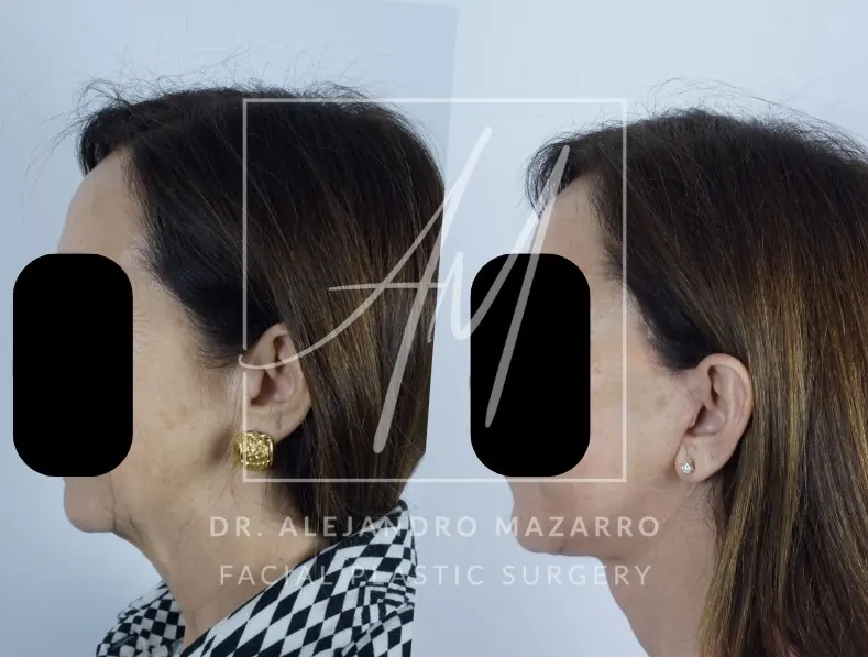 Preservation  Deep Plane Facelift- Dr. Mazarro