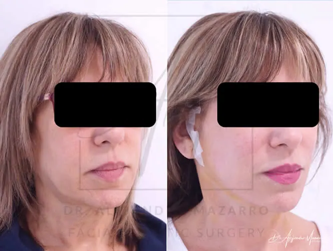 Lifting facial / Deep Plane Facelift- Dr. Mazarro