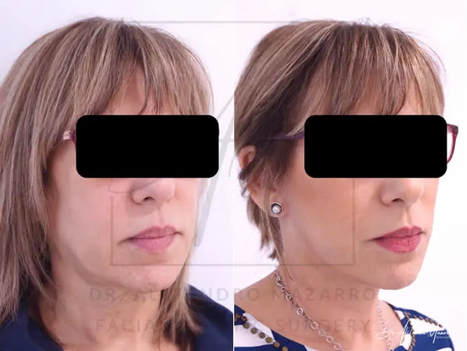 Lifting facial / Deep Plane Facelift- Dr. Mazarro