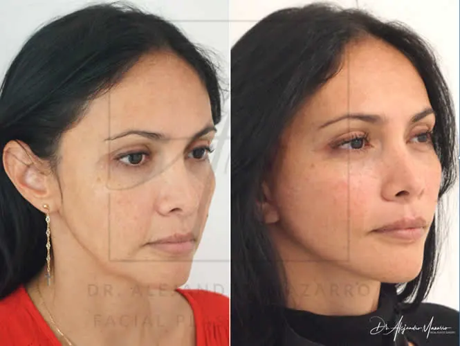Lifting facial / Deep Plane Facelift- Dr. Mazarro