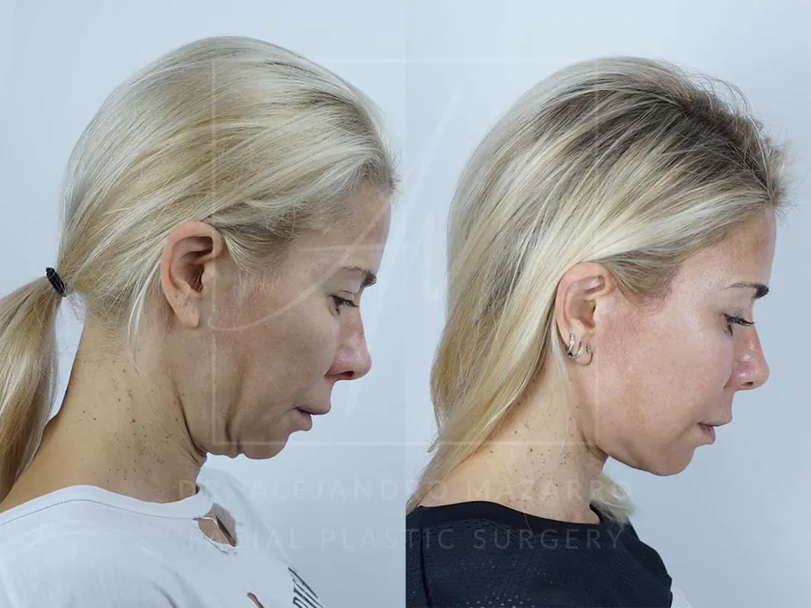 Lifting facial / Deep Plane Facelift- Dr. Mazarro