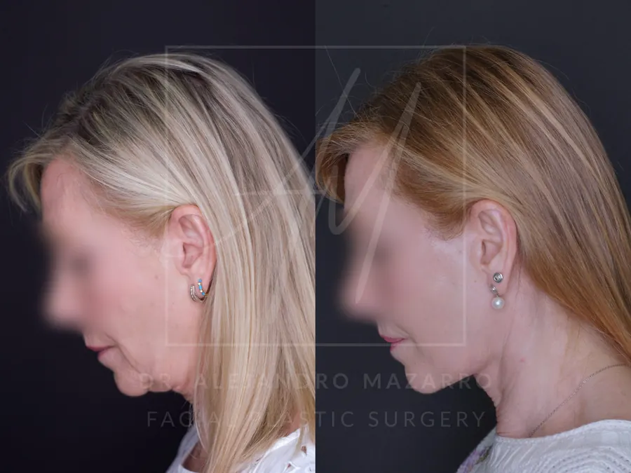 Lifting cervicofacial / Deep Plane Facelift- Dr. Mazarro