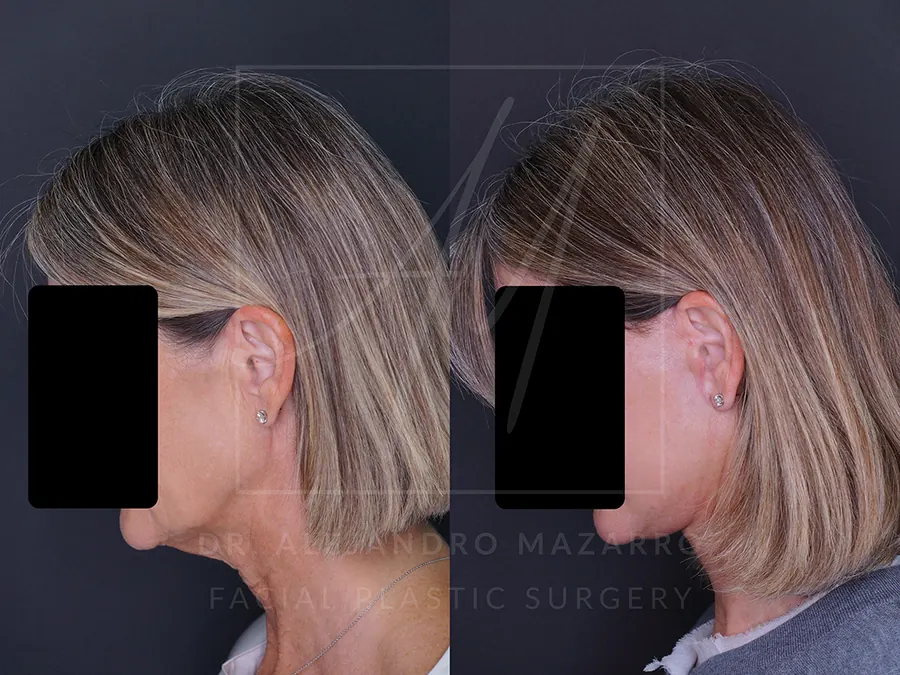 Lifting cervicofacial / Deep Plane Facelift- Dr. Mazarro