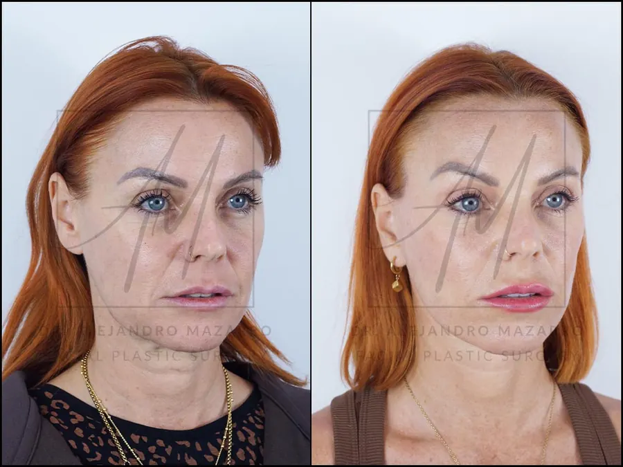 8-month result of a Preservation Deep Plane Facelift in a 47-year-old patient, with jawline definition and harmonious contour. Performed by Dr. Mazarro.