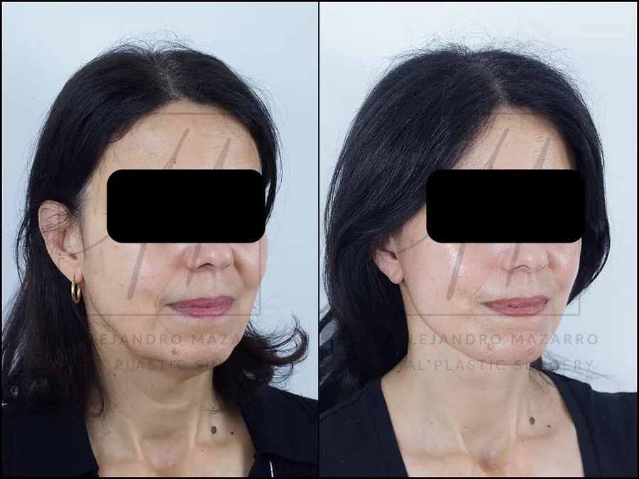 8-month result of preservation deep plane facelift and deep neck lift in a 56-year-old woman, right 3/4 view with defined facial contour and rejuvenated neck. Performed by Dr. Mazarro.