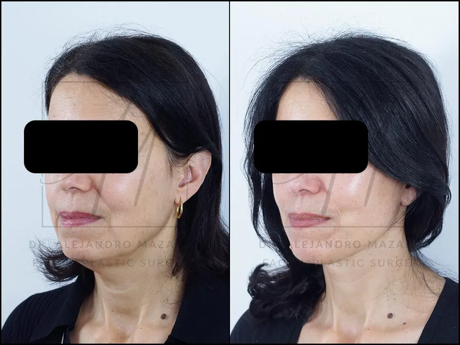 8-month result of preservation deep plane facelift and deep neck lift in a 56-year-old woman, left 3/4 view with defined facial contour and rejuvenated neck. Performed by Dr. Mazarro.