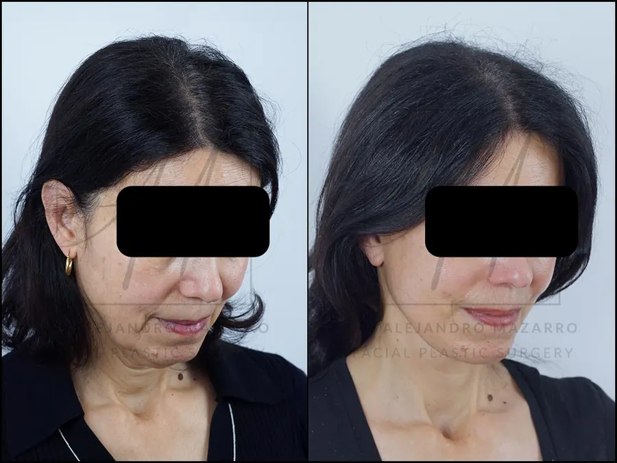 8-month result of preservation deep plane facelift and deep neck lift in a 56-year-old woman, right 3/4 view with chin down showing neck elegance and definition. Performed by Dr. Mazarro.