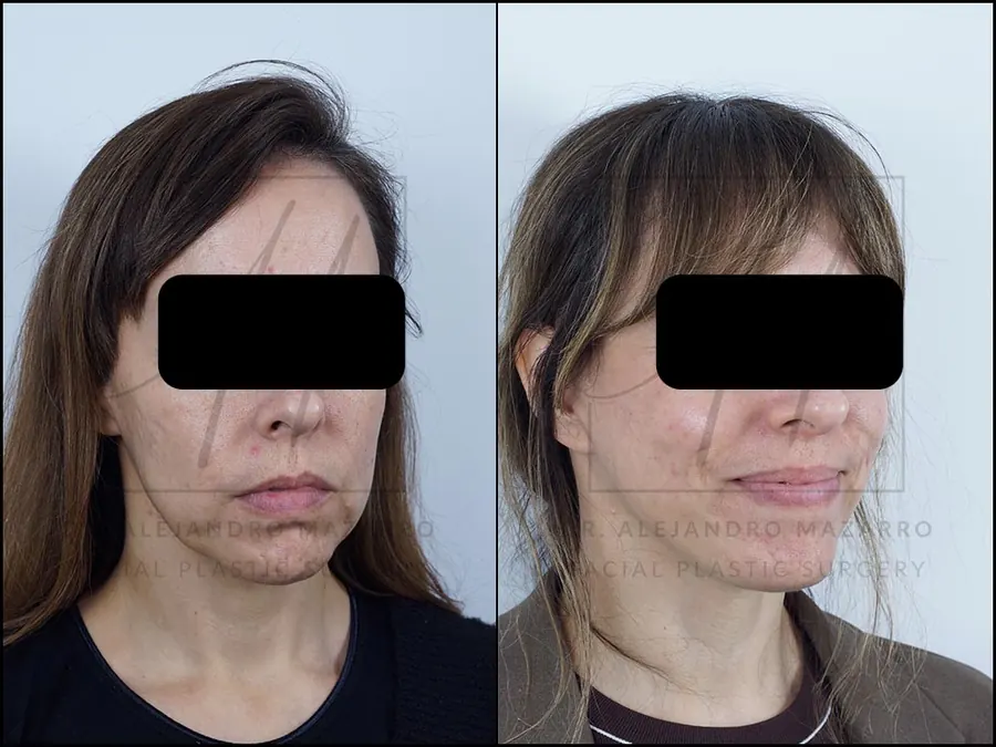 Lifting facial / Deep Plane Facelift- Dr. Mazarro