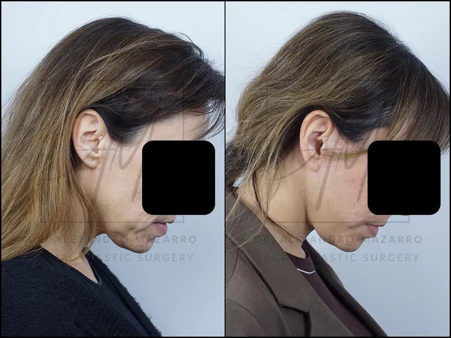 Lifting facial / Deep Plane Facelift- Dr. Mazarro