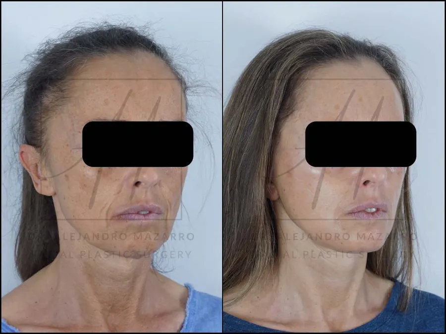 Lifting facial / Deep Plane Facelift- Dr. Mazarro