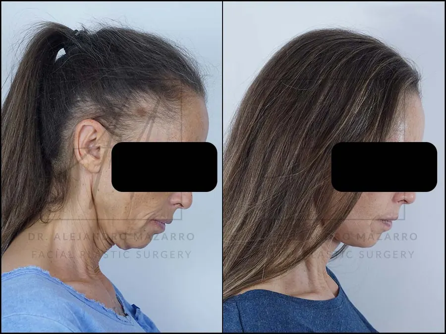 Lifting facial / Deep Plane Facelift- Dr. Mazarro