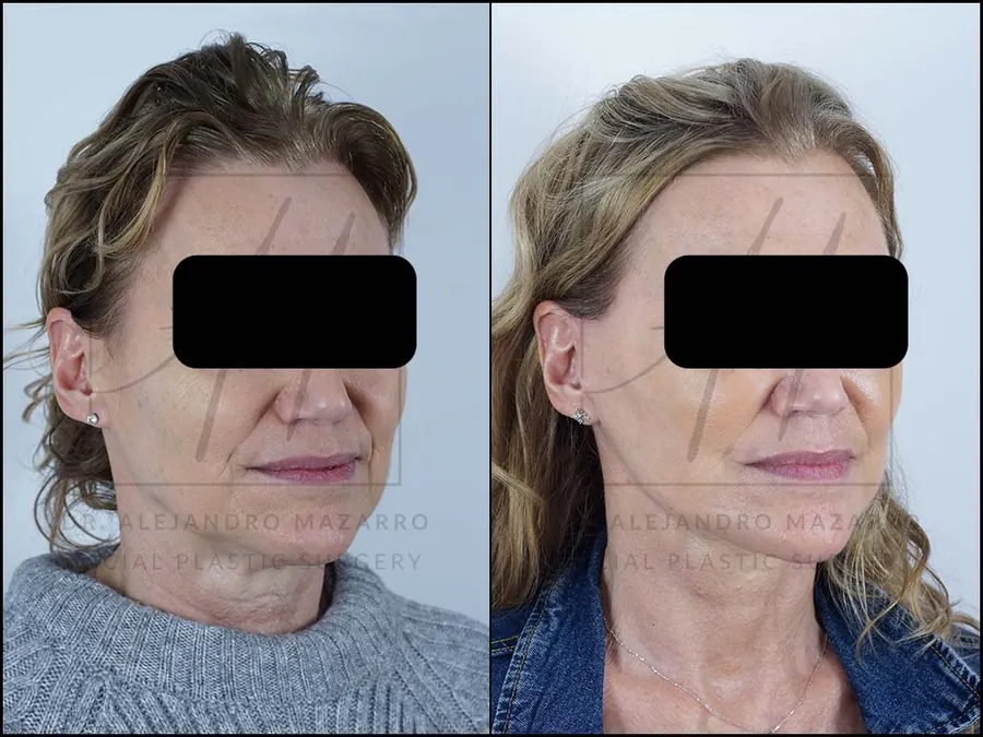 Lifting facial / Deep Plane Facelift- Dr. Mazarro