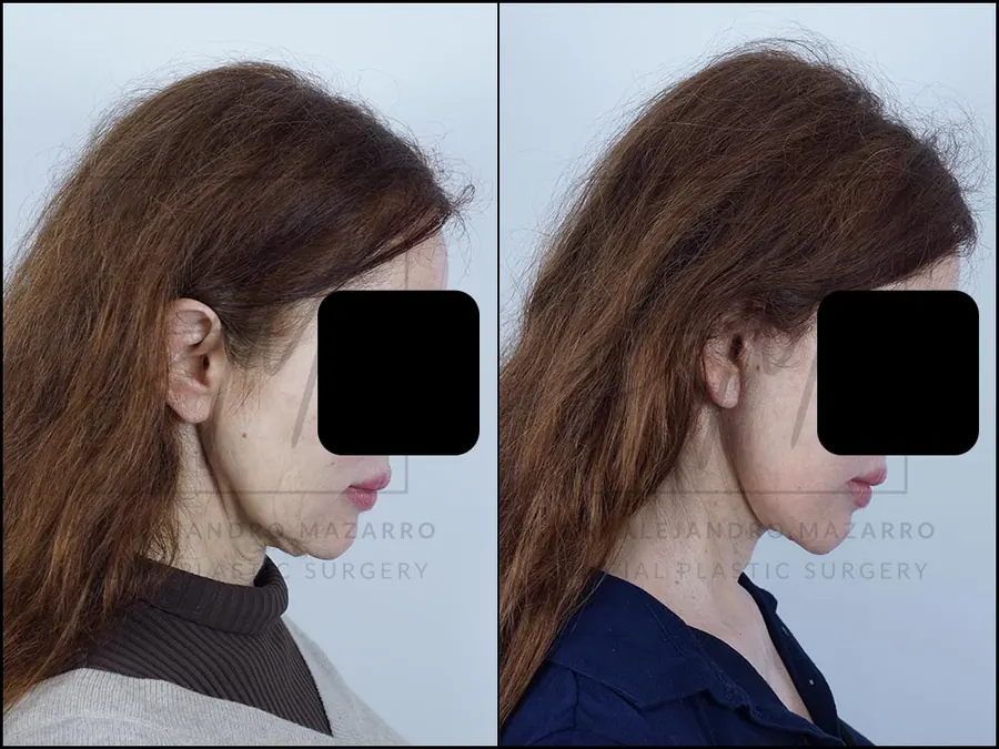 Paciente mujer 59 años - Vista perfil derecho con mentón hacia abajo antes y después de Lifting Cervicofacial Deep Plane de Preservación a 3 meses por el Dr. Alejandro Mazarro en Barcelona.